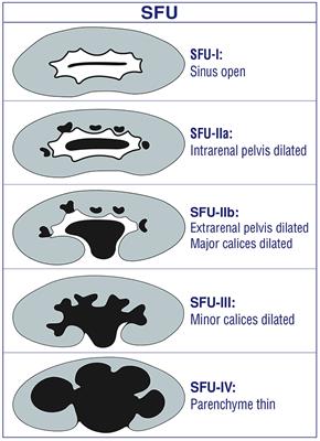 Grading of Hydronephrosis: An Ongoing Challenge